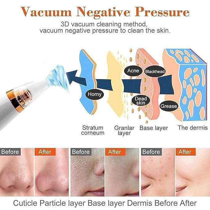 6 In 1 Derma Suction blackhead remover machine